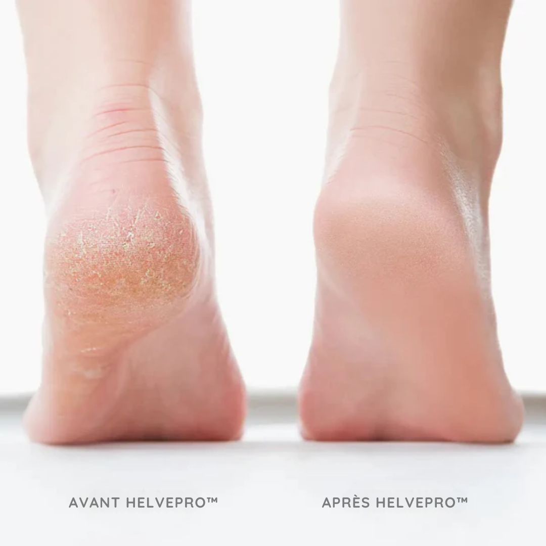 HelvePro™